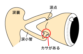 図：涙点に挿入するプラグ