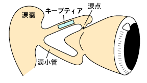図:涙小管に挿入するプラグ