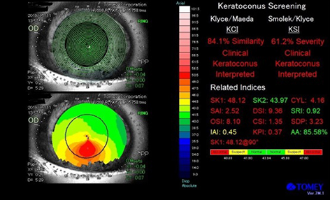 円錐角膜の角膜状態
