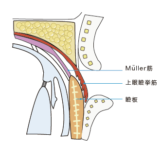 眼瞼下垂手術