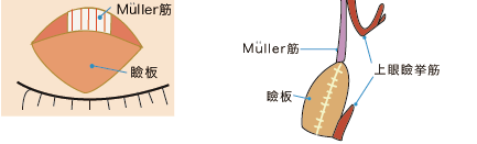 Müller筋を露出