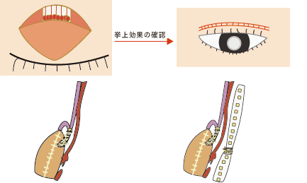 タッキング後