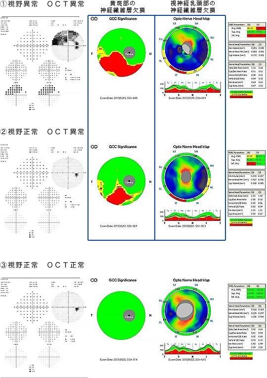 OCT・OCT angiography｜久里浜眼科