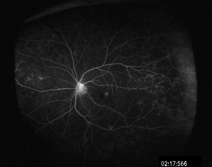 網膜静脈分枝閉塞症新生血管を伴う黄斑浮腫