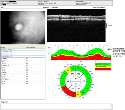 OCT RTVue-100 RNFL3.45