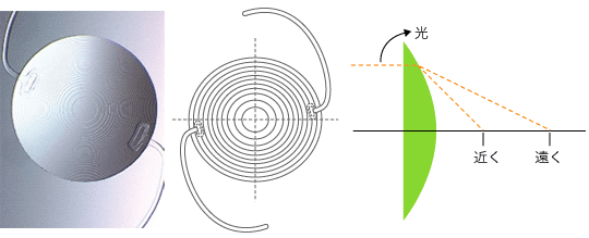 回折型眼内レンズ