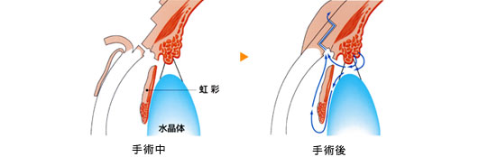 緑内障　視野のイメージ図