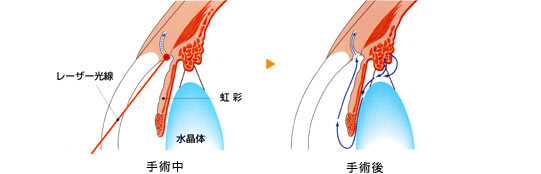 緑内障　視野のイメージ図