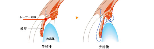 緑内障　視野のイメージ図