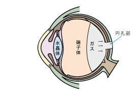 3.ガスを注入し円孔部を圧迫し、閉鎖を促す