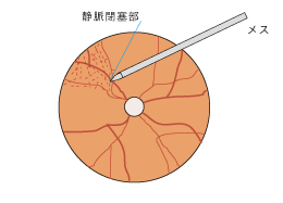 2.動脈と静脈の接している部位をメスで分離する