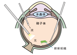 1.硝子体と呼ばれるゼリー状組織を除去