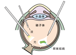 2.パーフルオロンを注入し網膜を伸ばしている所