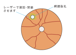 3.レーザーにて凝固、閉鎖させます