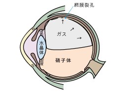 4.最後に眼内に必要に応じて ＳＦ6などのガスに置換する