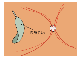 3.ICGで内境界膜を緑色の染色した後、再発予防のため、内境界膜を剥離します