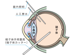 1.硝子体切除