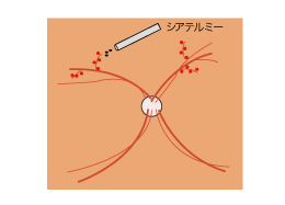 3.新生血管を電機凝固