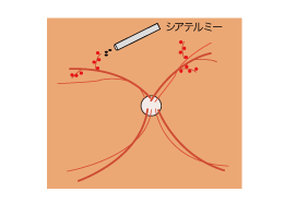 3.新生血管を電機凝固  