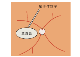 3、内境界膜の剥離をします