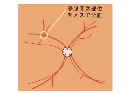 2、動脈と静脈の接している部位をメスで分離します