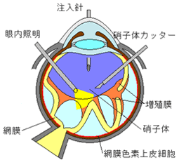 硝子体を切除し、増殖膜を剥がします