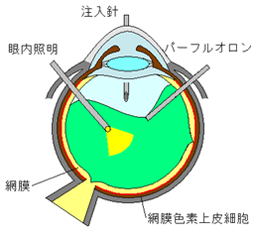 網膜を伸ばし、元の位置に戻します