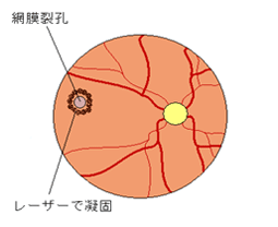 裂孔周囲をレーザーで凝固・閉鎖します