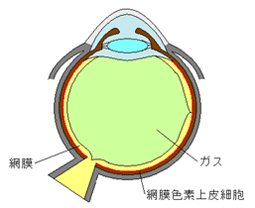 ガスやシリコーンオイルで網膜を押さえます