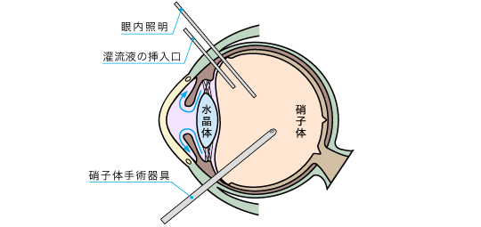 手術イメージ