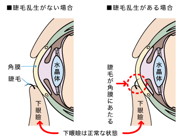 睫毛乱生_眼の断面図