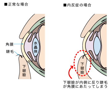 内反症_眼の断面図