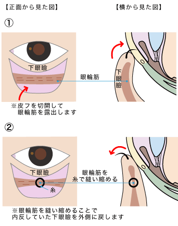 内反症手術の図